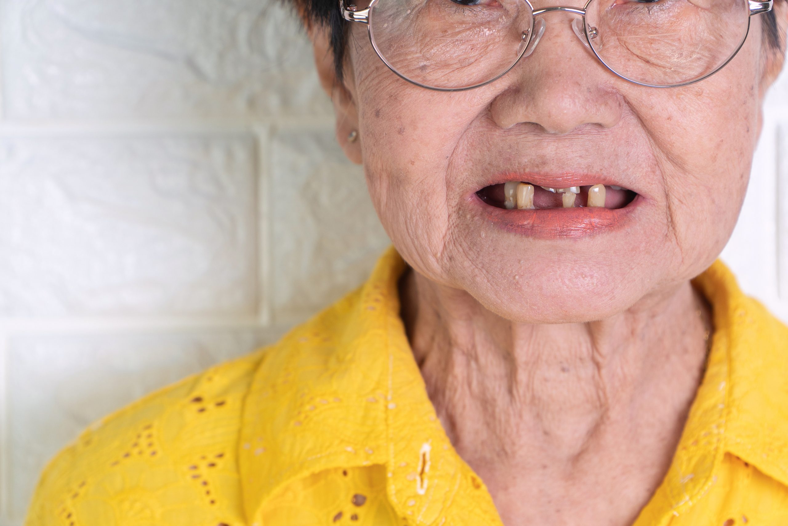 Why do we need to restore teeth?