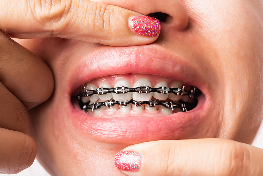 Can I get braces even though I’m an adult?