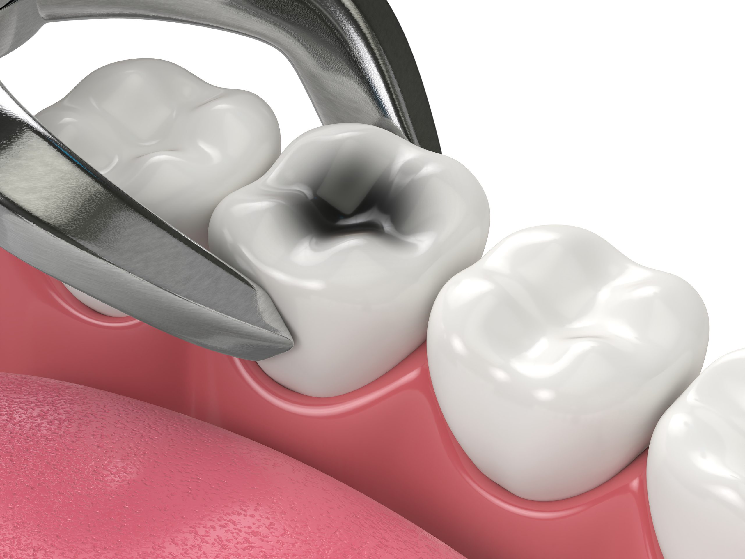 Types of Dental Extractions