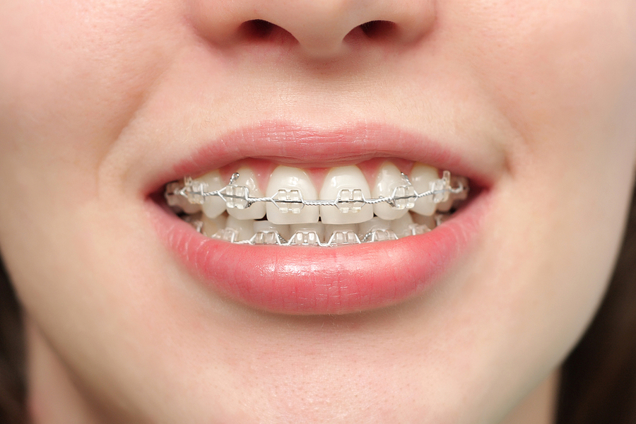 Achieving a Perfect Smile: Your Guide to Braces in Garland, TX