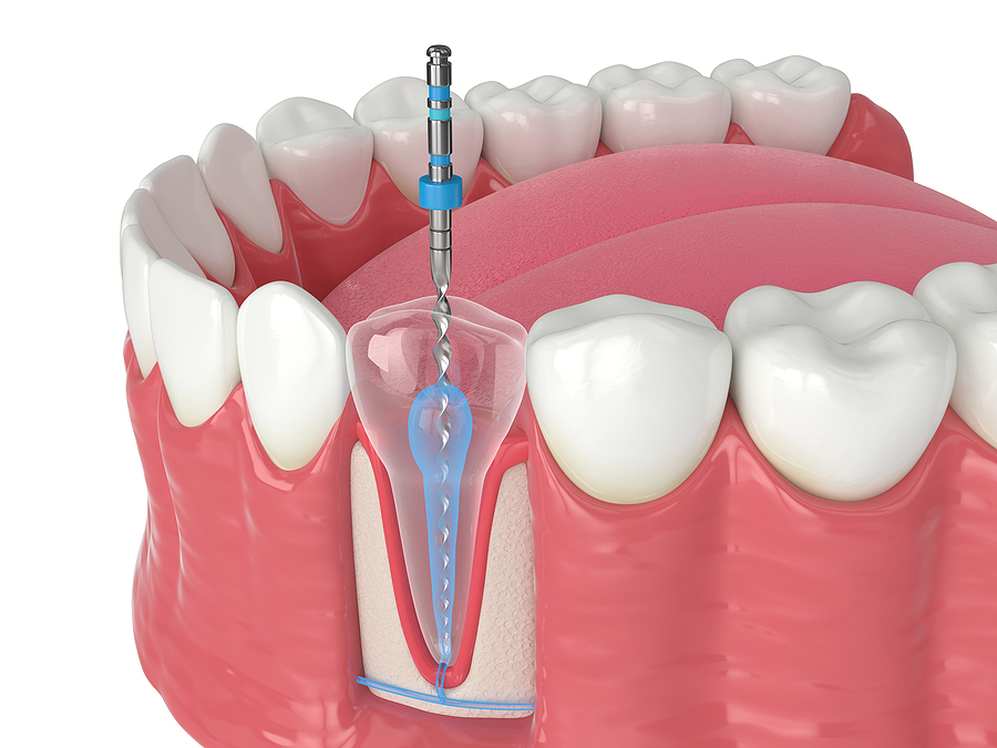 Understanding Endodontics: Preserving Your Natural Teeth